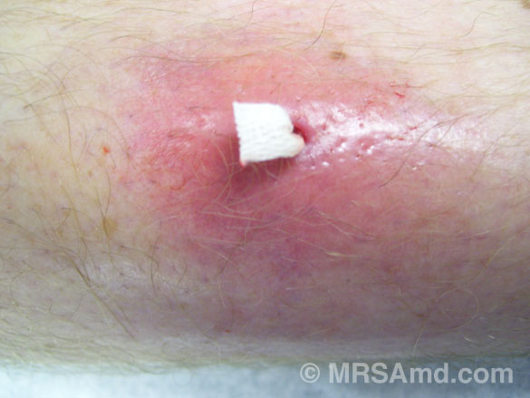 Which are the Most Common Antibiotics for Cellulitis?