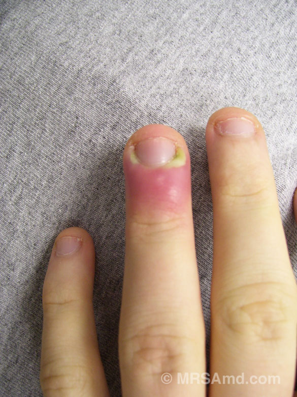 image-gallery-finger-abscess