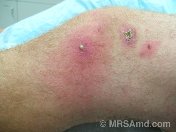 Cellulitis of the knee with pustule in center.