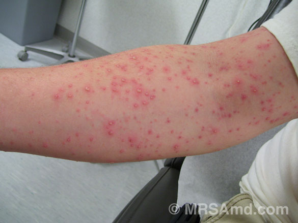 Where can you find pictures of MRSA skin infections?