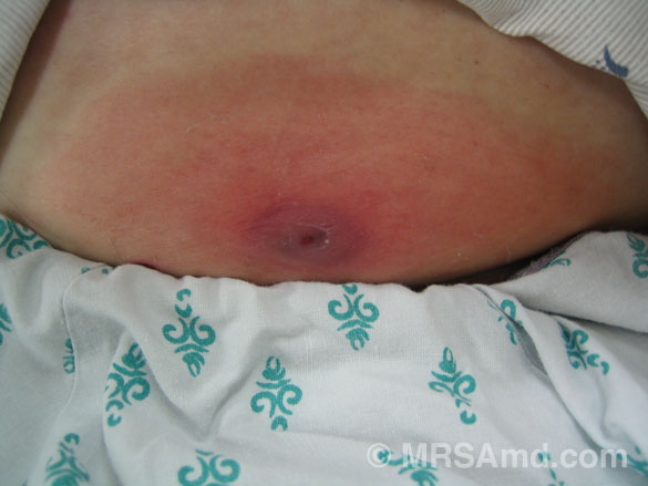 Image result for mrsa abdomen