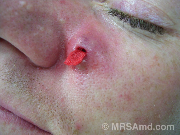 Mrsa Pictures 42