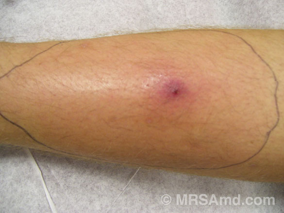 early stages staph infection on leg