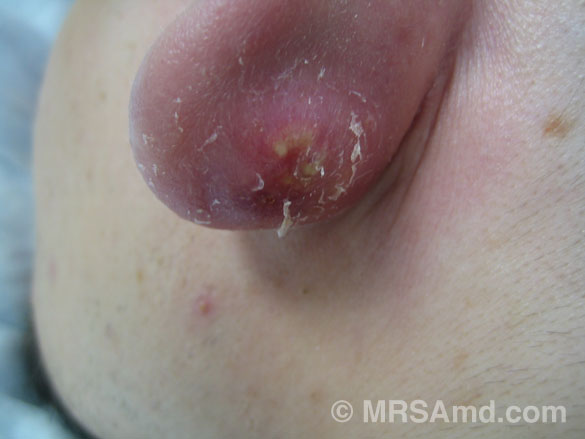 pimple vs mrsa